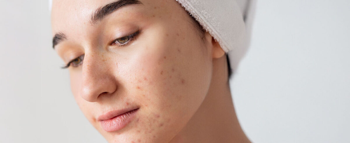 Skin care voor jongeren