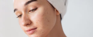 Blog banner Young Skin 300x122 - actualités -
