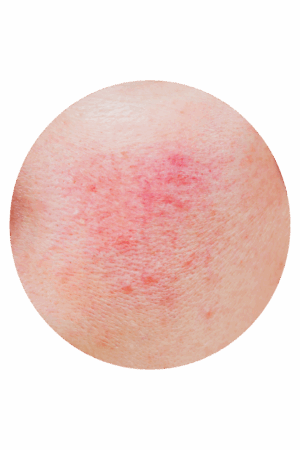 Rosacea huid